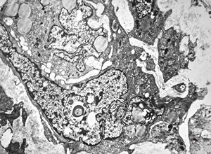 F,80y. | leiomyosarcoma - thigh F,80y. | leiomyosarcoma - thigh